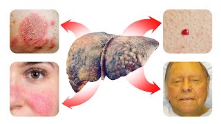 15 SKIN Signs that Reveal Your Liver is in Trouble [upl. by Dori695]