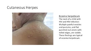 Cutaneous HerpesEczema Herpeticum [upl. by Atikkin]