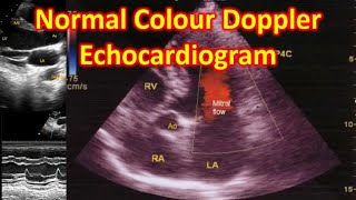 Normal colour Doppler Echocardiogram [upl. by Suki]