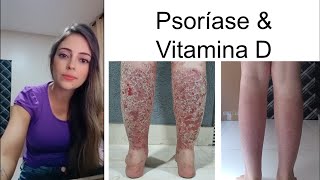 Aline  Psoríase e Artrite Psoriásica 817 [upl. by Botzow]