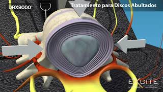 144  Imagenología de los cambios degenerativos de la columna vertebral y osteoporosis [upl. by Aihsenal506]