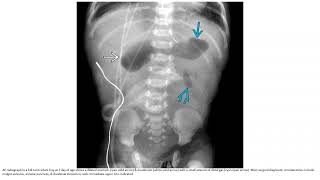 Duodenal Atresia or Stenosis Imaging [upl. by Nylesaj115]