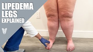 Lipedema Legs Explained  Dr Jaime Schwartz  Total Lipedema Care [upl. by Suoinuj]