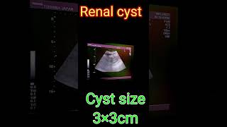 Renal cyst viralvideo ultrasound [upl. by Ducan246]