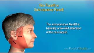 Steps of a Facelift Surgery [upl. by Nnilsia]