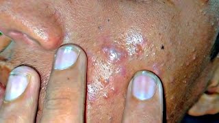 sac be spa blackheads elderly 2024  sac be spa old age blackheads 2024  sac be spa face scrub 461 [upl. by Galloway335]