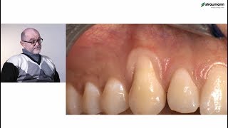 Prof Giovanni Zucchelli Treatment of class I gingival recession [upl. by Norina]