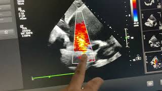 IVC type sinus Venosus ASD with partial anomalous pulmonary Venous connection ￼ [upl. by Polard]