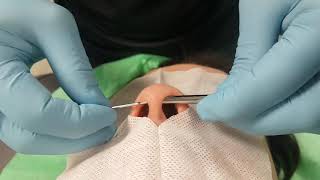 PERFORACIÓN SEPTUM EN NARIZ CON TABIQUE NASAL DESVIADO [upl. by Oletha294]