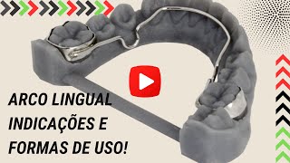 O arco Lingual Quais as suas indicações e formas de uso  Aula 152 [upl. by Ariak]