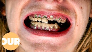 Can My Rotten Teeth Be Saved  Our Life [upl. by Jonathan]