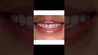 porcelain veneers  porcelain veneers process  Porcelain veneers vs Composite Veneers  Dr Yazdan [upl. by Elaynad493]