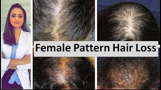 Hair loss in women  Female Pattern Hair Loss  causes amp treatment  Dermatologist [upl. by Onirefes]