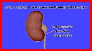 Obstruction Removal at the Ureteropelvic Junction UPJ through Holmium Laser [upl. by Adnahc334]