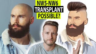 Baldcafe GOOD HAIR TRANSPLANT CANDIDATE or NOT Realistic View and Expectations [upl. by Gweneth38]