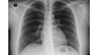 Chest xray Right lower lobe collapse [upl. by Caton130]