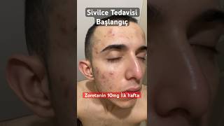 SİVİLCE TEDAVİSİ PART1  Zoretanin 10mg  shorts ciltbakımı sivilcetedavisi [upl. by Jowett]