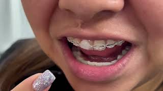 How to apply ortho wax to your braces [upl. by Cardew]