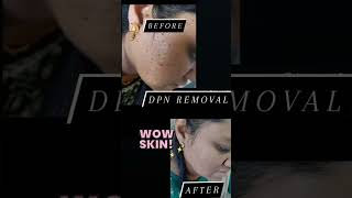 DPN Removal  Cosmetologist in Wagholi  Dr Priyanka Patil [upl. by Anhpad]