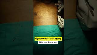 Gynecomastia result in delhi  Suture removal [upl. by Alle414]