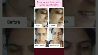 acne scars permanent removing treatment [upl. by Auqenehs145]