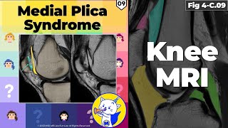 Fig 4C09 Medial Plica Syndrome [upl. by Tarfe]