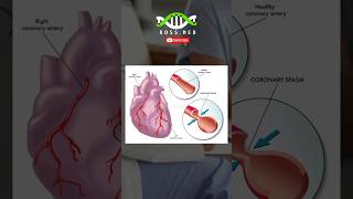 ANGINA PRINZMETAL EN 1MIN medicina angina doctor hospital dolor [upl. by Olmsted]