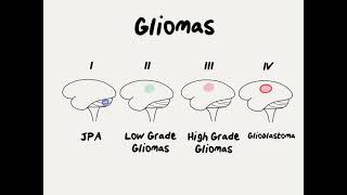 Doctor Explains Glioma Brain Tumor [upl. by Evans532]