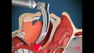 Endotracheal Intubation Animation [upl. by Kelly]