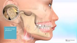 Carriere® Motion™ Appliance for Class II Patient Education Animation [upl. by Ayekin293]