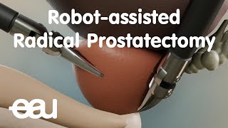 Robotassisted Radical Prostatectomy RARP [upl. by Aniroc]