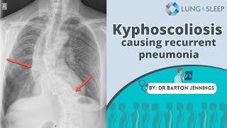 Kyphoscoliosis causing recurrent pneumonia [upl. by Artied]