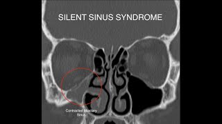 Silent Sinus Syndrome [upl. by Pogue668]