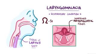 Laryngomalacia causes symptoms diagnosis treatment pathology [upl. by Suriaj198]