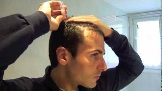 Tratamiento laser capilar domiciliario  Hair loss laser treatment home use [upl. by Loux]