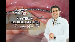 Double wire traction in orthodontics piggyback for lateral cross bite by Dr Amr Asker [upl. by Peck22]