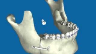 Retroceso de Mandíbula por Prognatismo Mandibular [upl. by Ilke535]