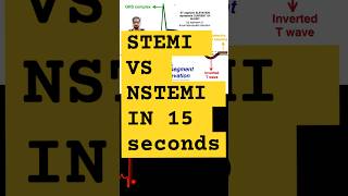 STEMI vs NSTEMiecg ST segment elevation vs ST segment depression stemi  cathlab [upl. by Sirdi449]