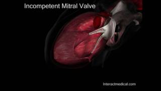 Mitral Valve normal and incompetent [upl. by Temp]