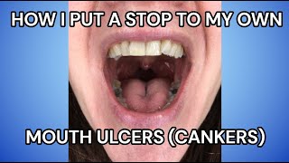 Best Mouth Ulcer  Canker Home Remedy Treatment IBD Sufferers [upl. by Ezirtaeb]