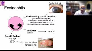 Lecture Vernal Keratoconjunctivitis [upl. by Trebornhoj]