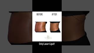 Laser Lipo Before And After  Noninvasive Body Sculpting [upl. by Imogene]