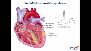 WPW syndrome CVS [upl. by Intihw]