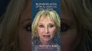 Resultado antes y después cirugía plástica de lifting  blefaroplastia  láser co2 [upl. by Sarchet]