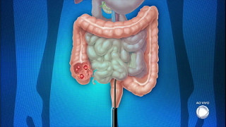 Você e o Doutor saiba tudo sobre os males do intestino [upl. by Dikmen]