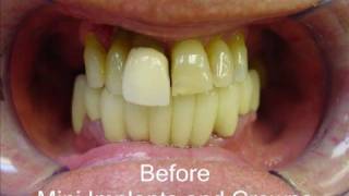 Mini Dental Implants  Before and After [upl. by Niltiac]