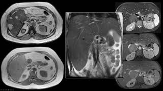 34 MR Imaging of Hepatic Adenomas Subtypes and Their Management  Part 1 By Dr Alice Fung [upl. by Blunt]