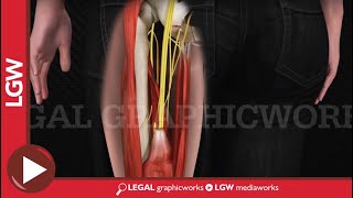 Hamstring Repair Surgery 3D animation [upl. by Fax]