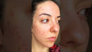 Remove Acne In 10 Days  shorts shortsfeed trending [upl. by Ayetal]