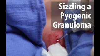 Sizzling a Pyogenic Granuloma [upl. by Ayaros]